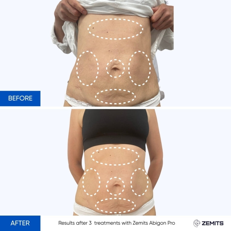 Zemits Abigon Pro Sistema de Remodelação Corporal e Emagrecimento Ultimate